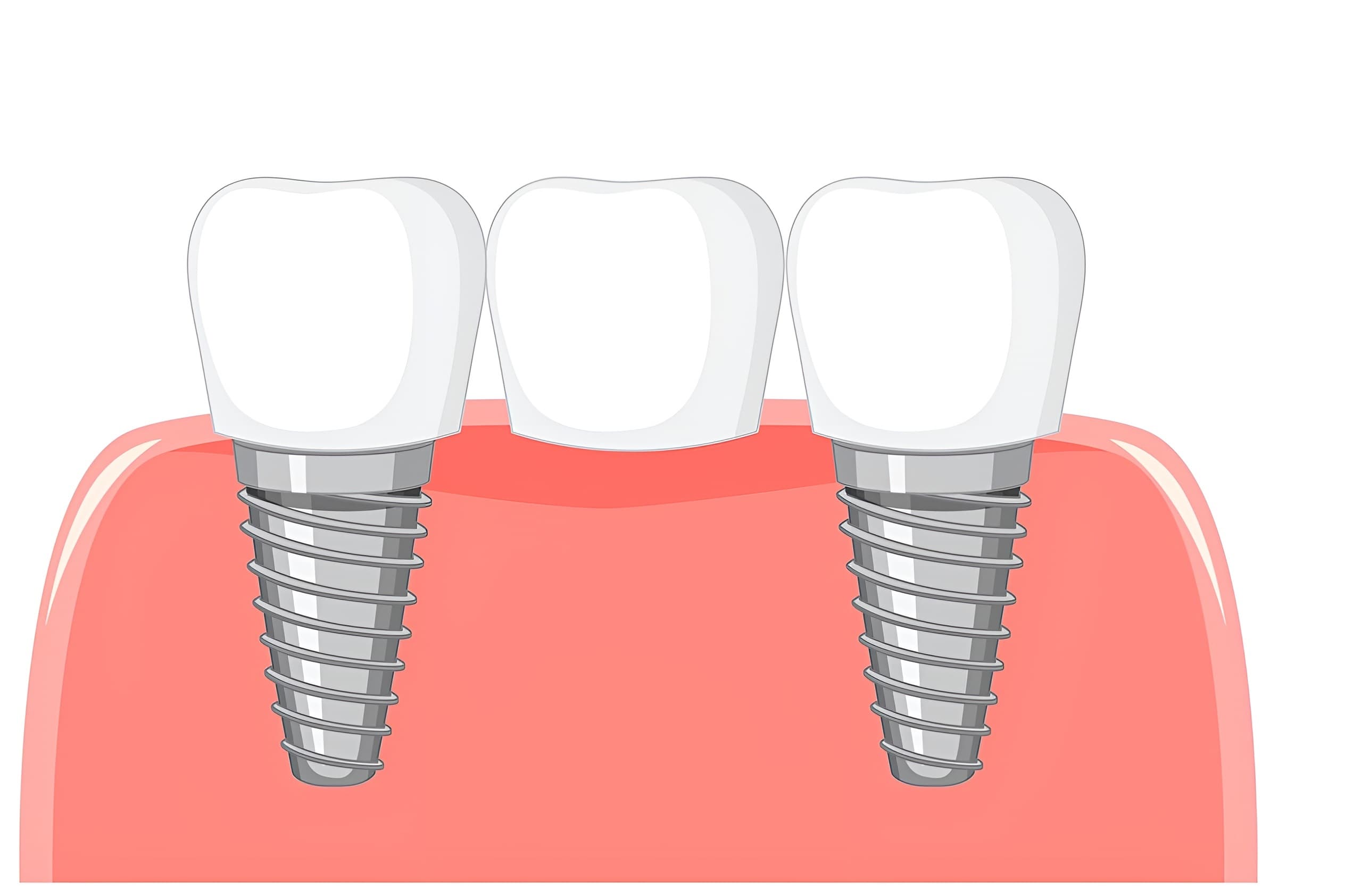 Bridges & Crowns — Restore Strength & Beauty